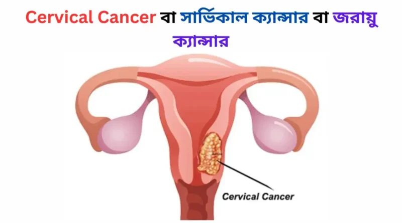 Cervical Cancer বা সার্ভিকাল ক্যান্সার বা জরায়ু ক্যান্সার