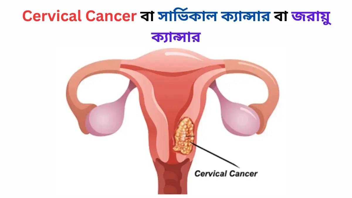 Cervical Cancer বা সার্ভিকাল ক্যান্সার বা জরায়ু ক্যান্সার